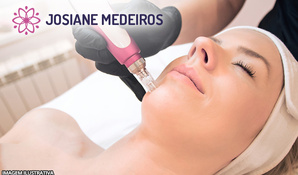 2 sessões de micropuntura para estrias ou rugas na Josiane Medeiros Estética